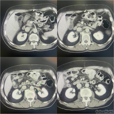 Case Report: Recurrent colonic metastasis from lung cancer—diagnostic pitfalls and therapeutic challenge of a peculiar case